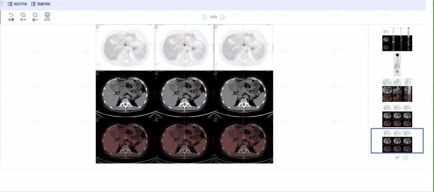 Kasus konsultasi jarak jauh untuk peritoneal carcinosarcoma